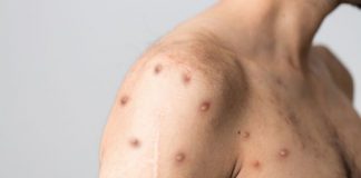 Profilul bolnavului de variola maimuței făcut de OMS :”Gay  sub 40 de ani”