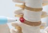 3 lucruri despre hernia de disc lombară pe care oricine trebuie să le cunoască