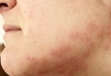 „Canibalul” de la Hârlău! Acuzat că şi-a muşcat iubita de faţă!