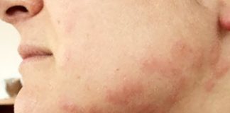 „Canibalul” de la Hârlău! Acuzat că şi-a muşcat iubita de faţă!